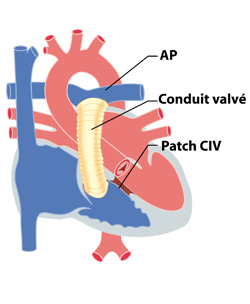 Cardiologie Des Enfants Les Principales Malformations