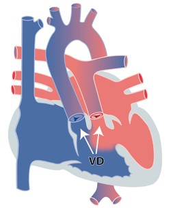 Cardiologie Des Enfants Les Principales Malformations