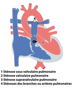Cardiologie des enfants - Les principales malformations congénitales du  coeur chez l'enfant - Anomalies des valves et vaisseaux - Cliniques  universitaires Saint-Luc